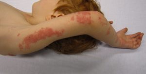 What Are Shingles And Its Symptoms On The Body?